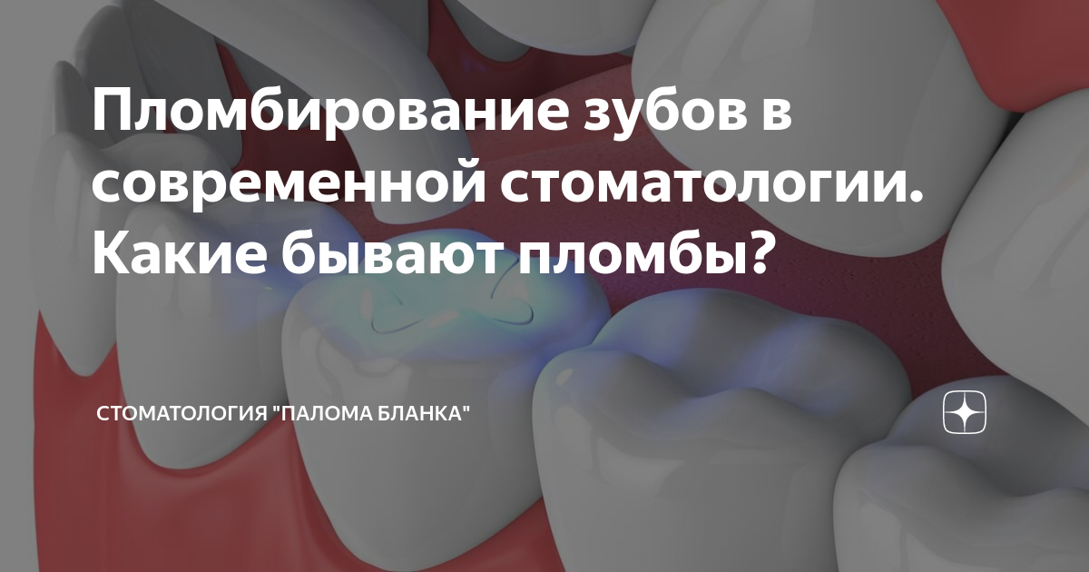 Пломбирование зубов в современной стоматологии. Какие бывают пломбы ...