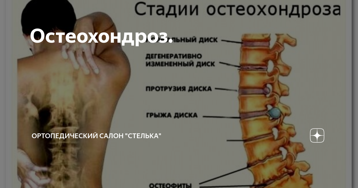 Стадии остеохондроза грудного отдела позвоночника. Остеохондроз позвоночника. Полисегментарный остеохондроз. Остеохондроз поясничного отдела. Полисегментарный остеохондроз поясничного отдела.