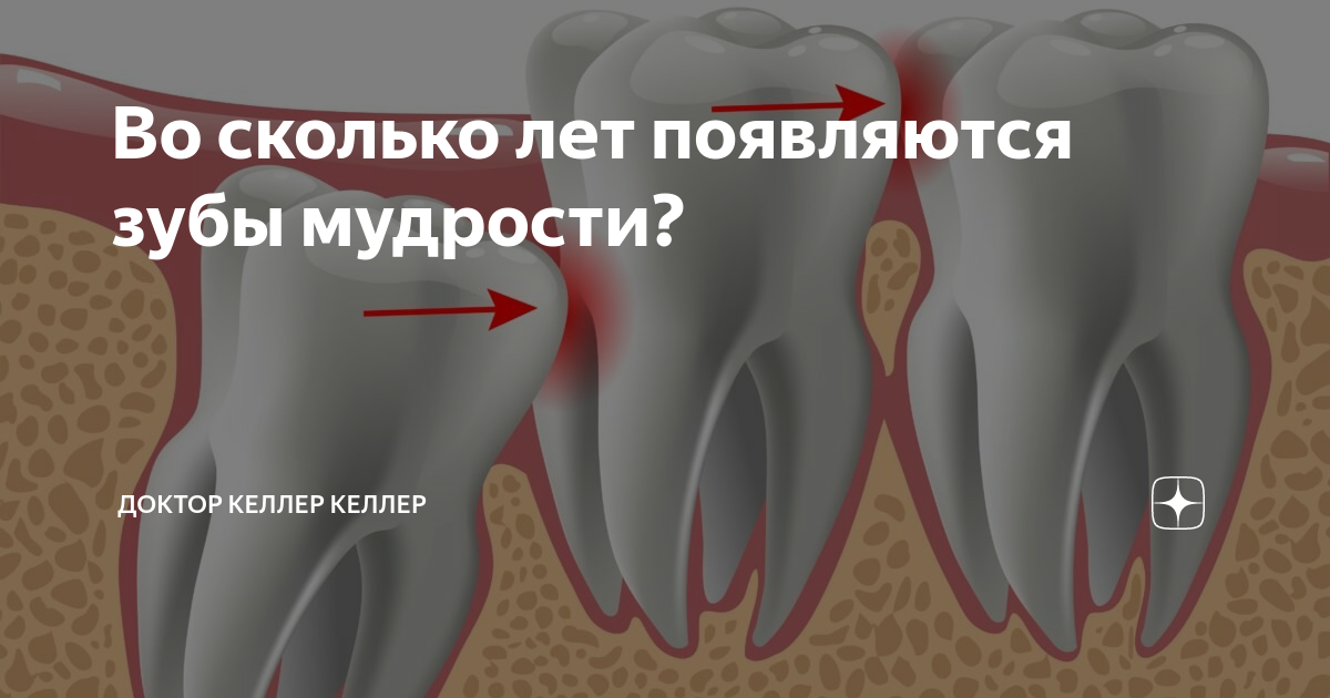 Почему зубы мудрости так называются. Прорезается зуб мудрости.