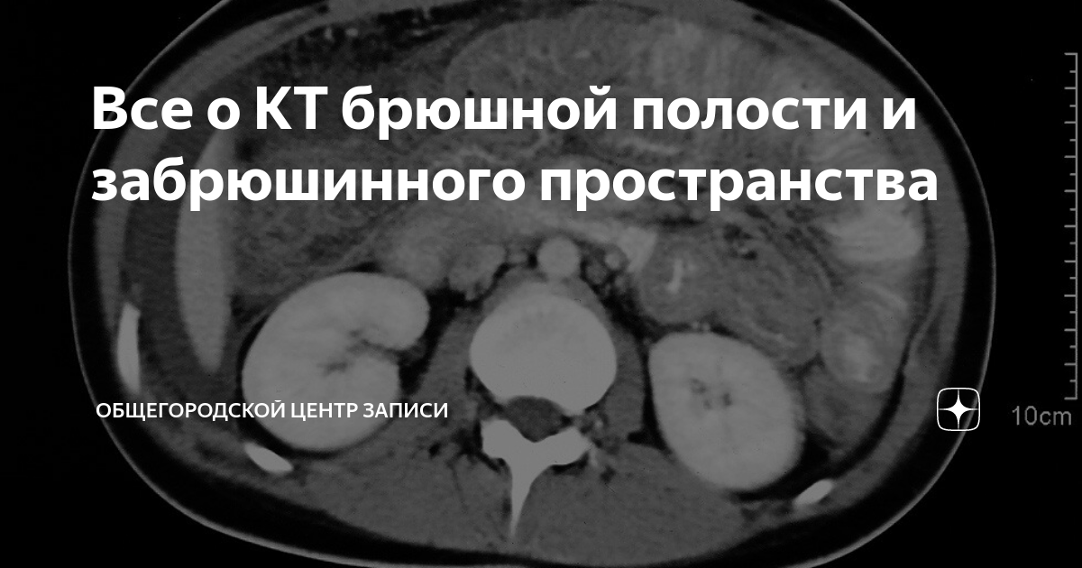 Сделать кт забрюшинного пространства. Сделать кт забрюшинного пространства. Сделать кт забрюшинного пространства. Кт томография брюшной полости. Забрюшинный абсцесс на кт.