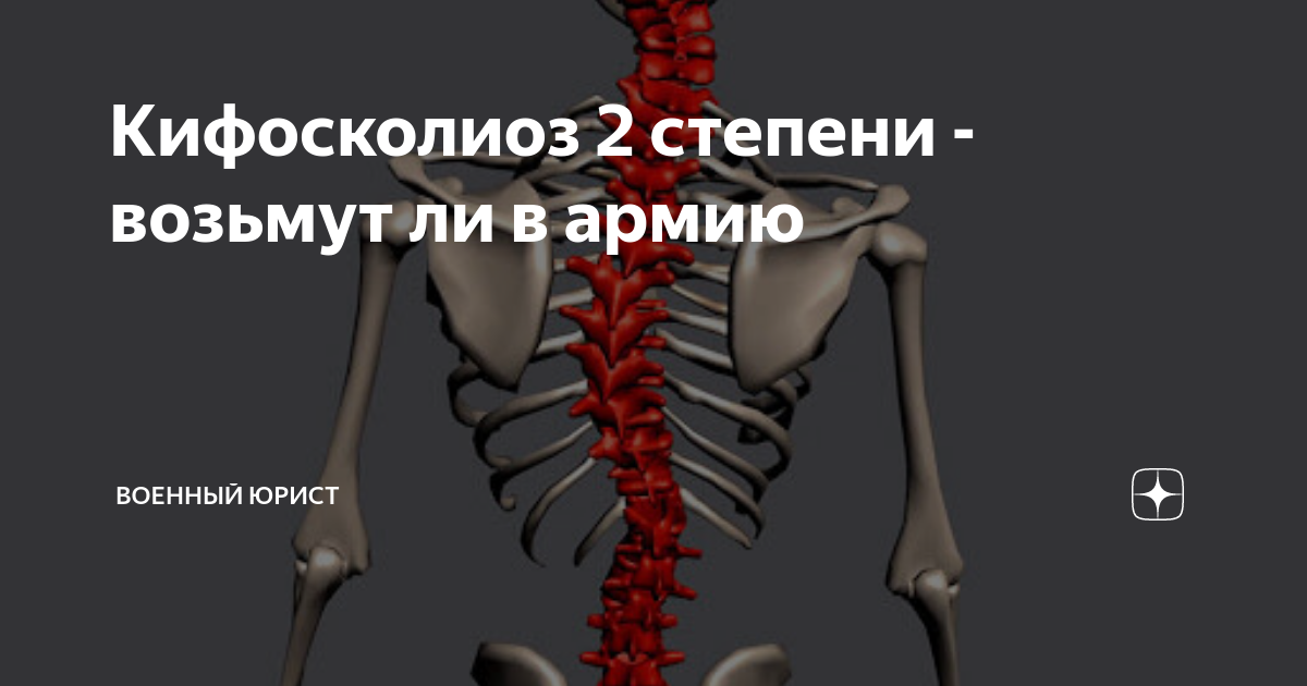 Кифосколиоз 2 степени - возьмут ли в армию | Военный юрист | Дзен