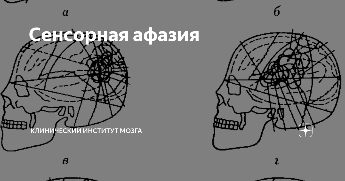Сенсорная афазия | Клинический Институт Мозга | Дзен