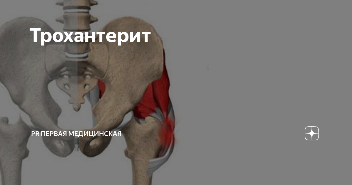 Трохантерит тазобедренного лечение у женщин после 60. Трохантерит тазобедренного лечение у женщин после 60