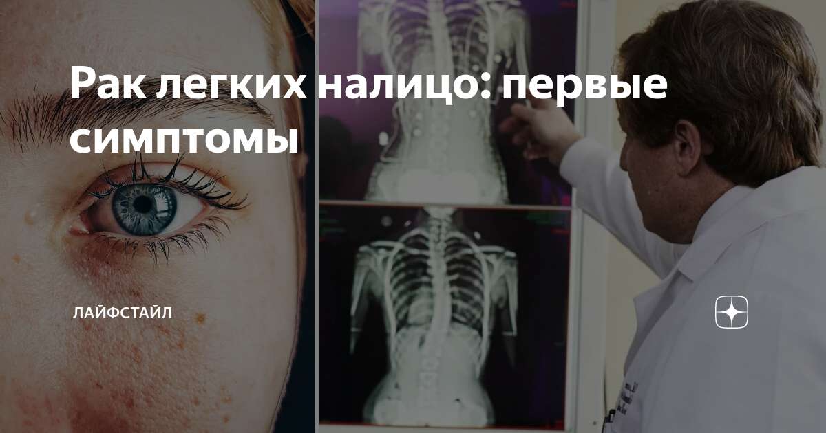 Рак легких налицо: первые симптомы | Лайфстайл | Дзен