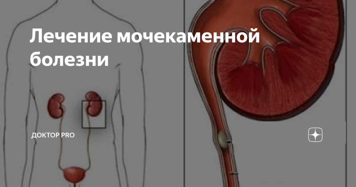 С опозданием поздравляю с днем рождения. Эми понд. Врач и пациент карикатура. Путь камня из почки у мужчин. Лечение мочекаменной болезни нефростома.