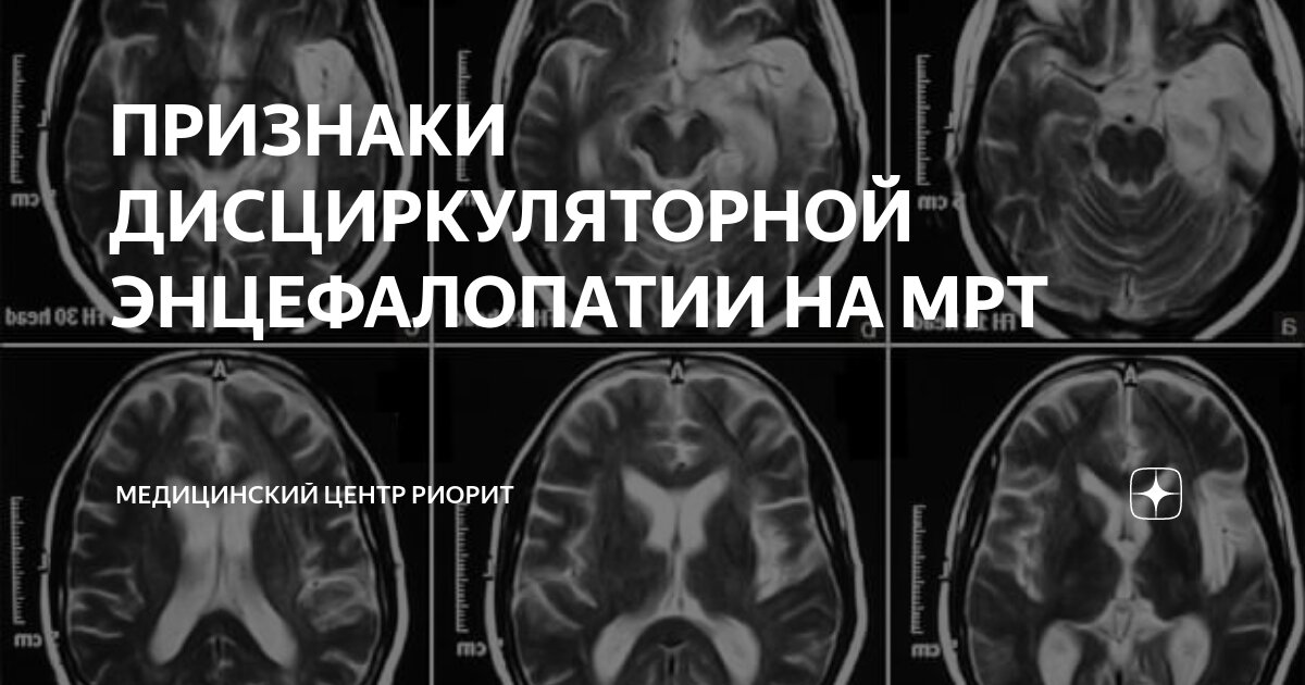 Мр картина дисциркуляторной энцефалопатии смешанной заместительной гидроцефалии