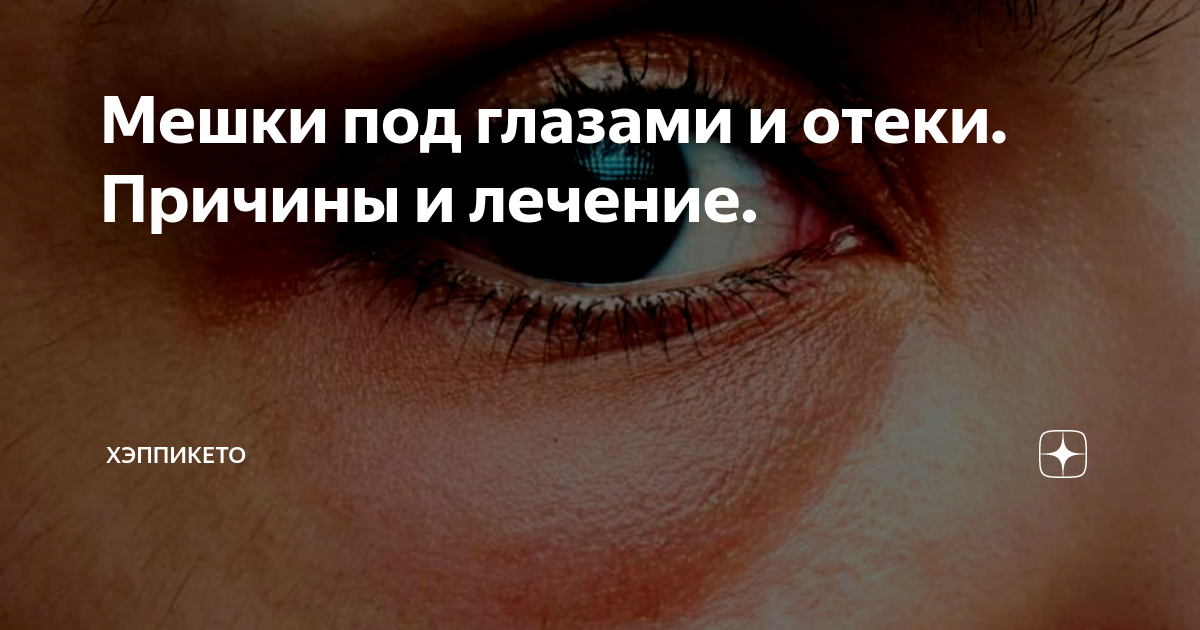 Мешки под глазами и отеки. Причины и лечение. | Томшина Наталья ...