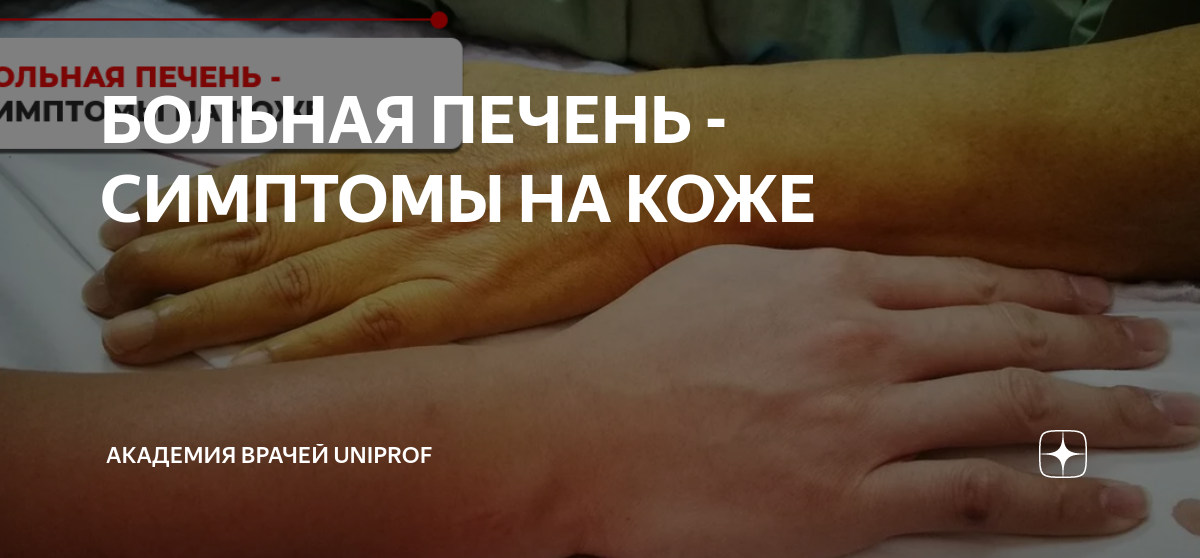 БОЛЬНАЯ ПЕЧЕНЬ - СИМПТОМЫ НА КОЖЕ | Академия врачей UniProf | Дзен