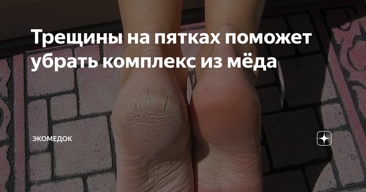 мазь для заживления трещин на пятках. глицерин с уксусом для пяток. каких витаминов не хватает если. трещины в уголках губ какого витамина не хватает. средство от потрескавшихся пяток.