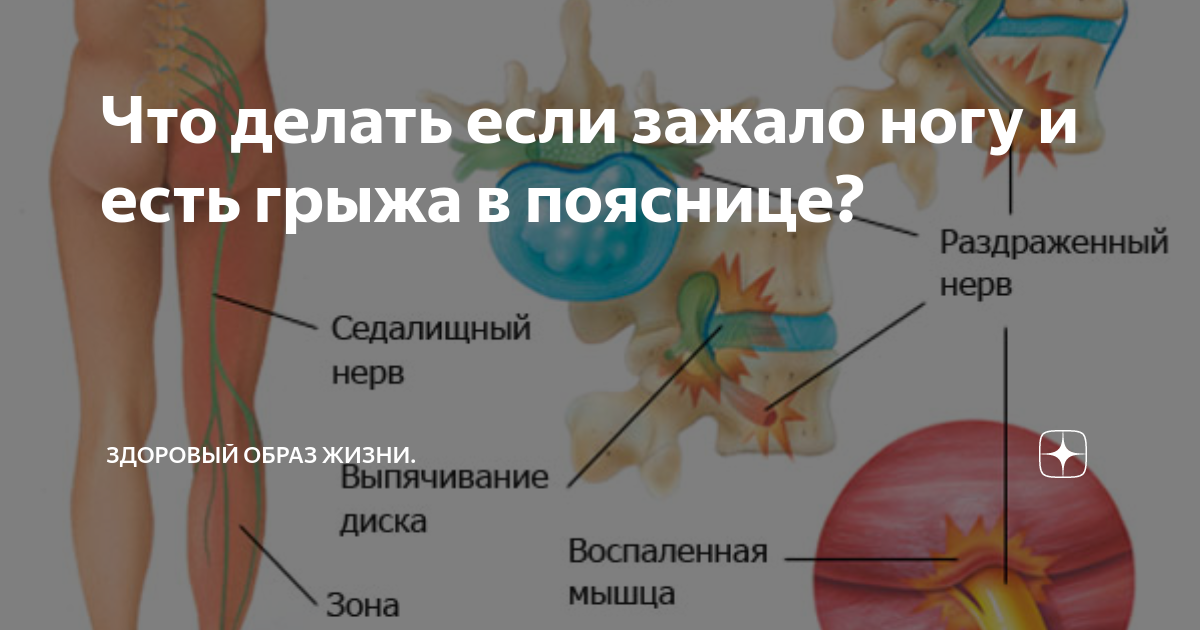 Защемление нерва в пояснице. Седалищный нерв где находится фото. Зажатие грыжи седалищного нерва.