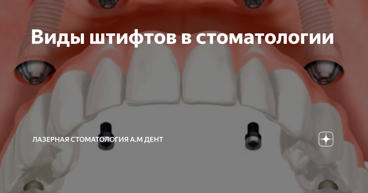 Виды штифтов в стоматологии | Лазерная стоматология А.М Дент | Дзен