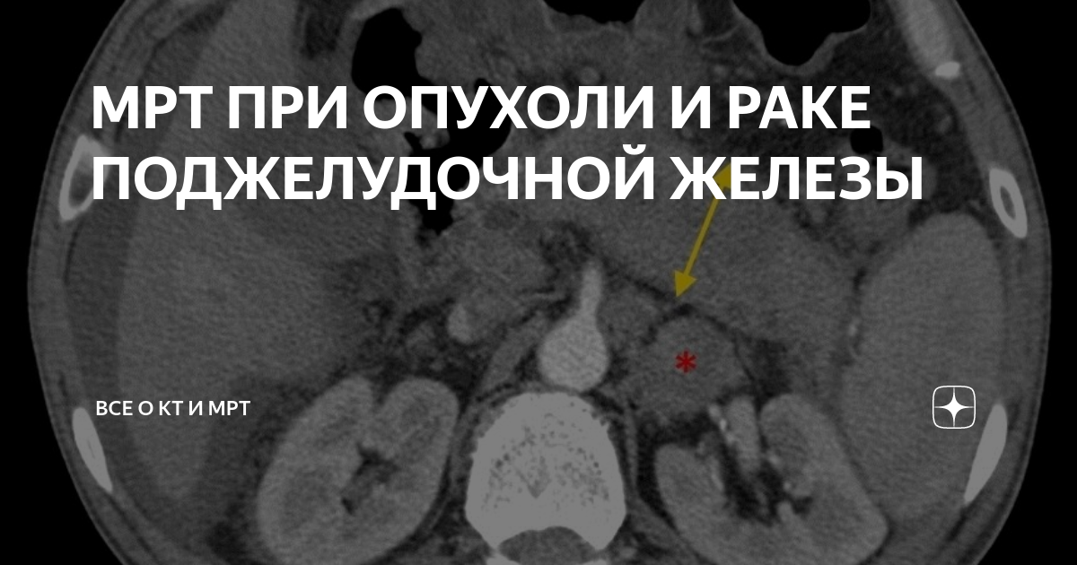 Кт или мрт поджелудочной. Кистозные опухоли поджелудочной железы мрт. Мрт при опухоли. Мрт зоны исследования. Псевдоциста поджелудочной кт.