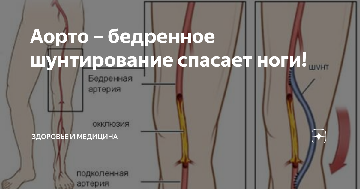 Шунтирование смертность. Аортобедренного шунтирования. Шунтирование бедренной артерии. Шунт подвздошной артерии. Аортобедренного шунтирования техника.