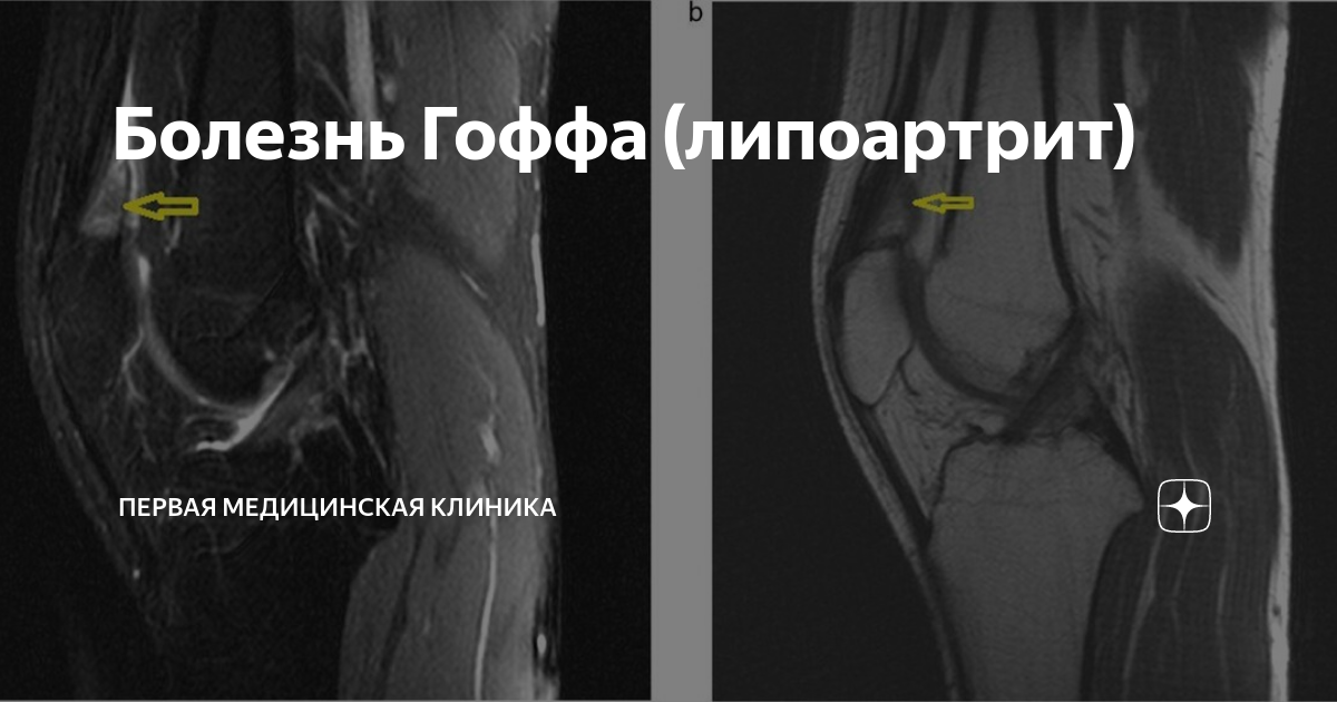 Что такое болезнь Гоффа и как её лечат - Лайфхакер