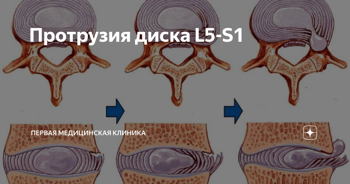Дегенеративные изменения межпозвонкового диска l5 s1 Дегенеративные изменения межпозвонкового диска l5 s1
