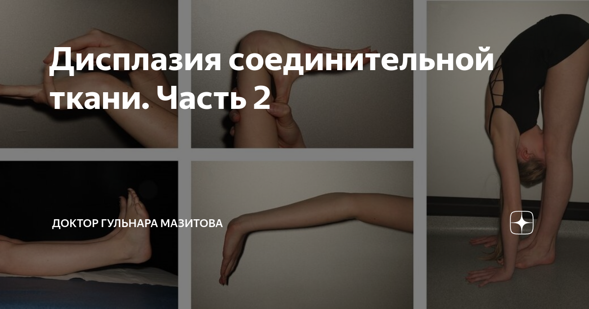 Дисплазия соединительной ткани у детей: симптомы синдрома с фото и лечение патол