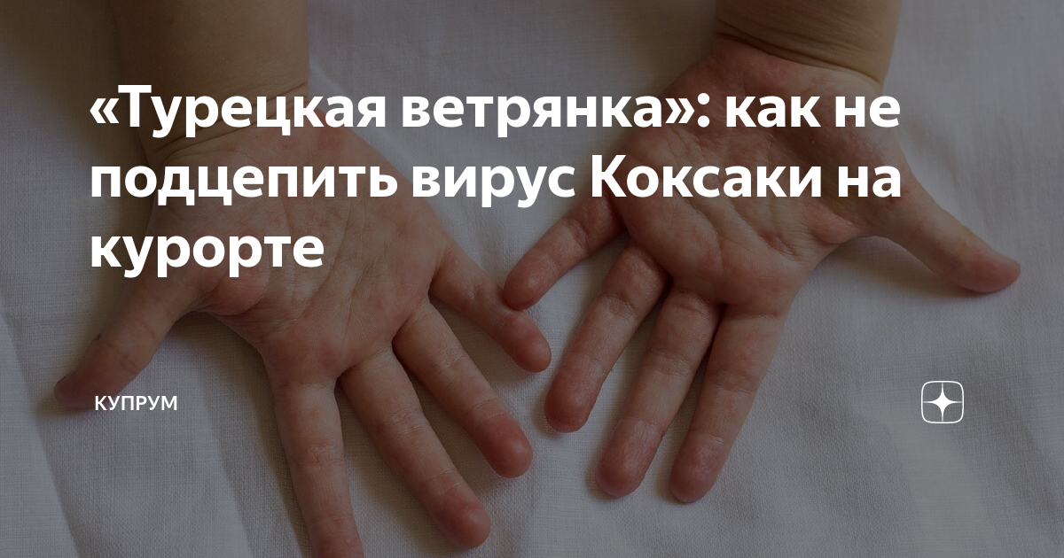 Enterovirus 71 Infection..Hand, foot, and mouth disease. Векторный объект Stock 