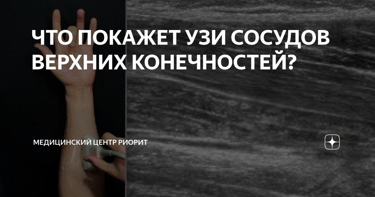 ЧТО ПОКАЖЕТ УЗИ СОСУДОВ ВЕРХНИХ КОНЕЧНОСТЕЙ? | Медицинский центр РИОРИТ ...
