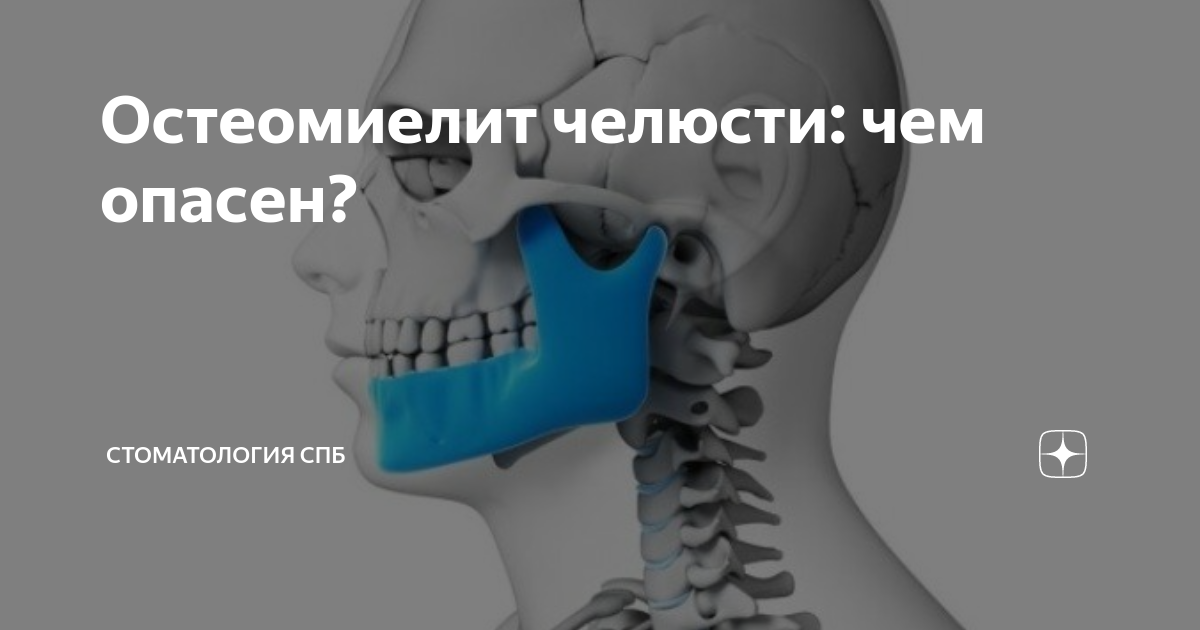 Основные симптомы остеомиелита нижней челюсти – информация для пациентов — клиника «Добробут»