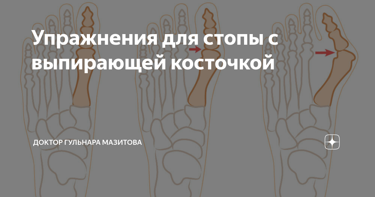 Упражнения для стопы с выпирающей косточкой | Доктор Гульнара Мазитова ...