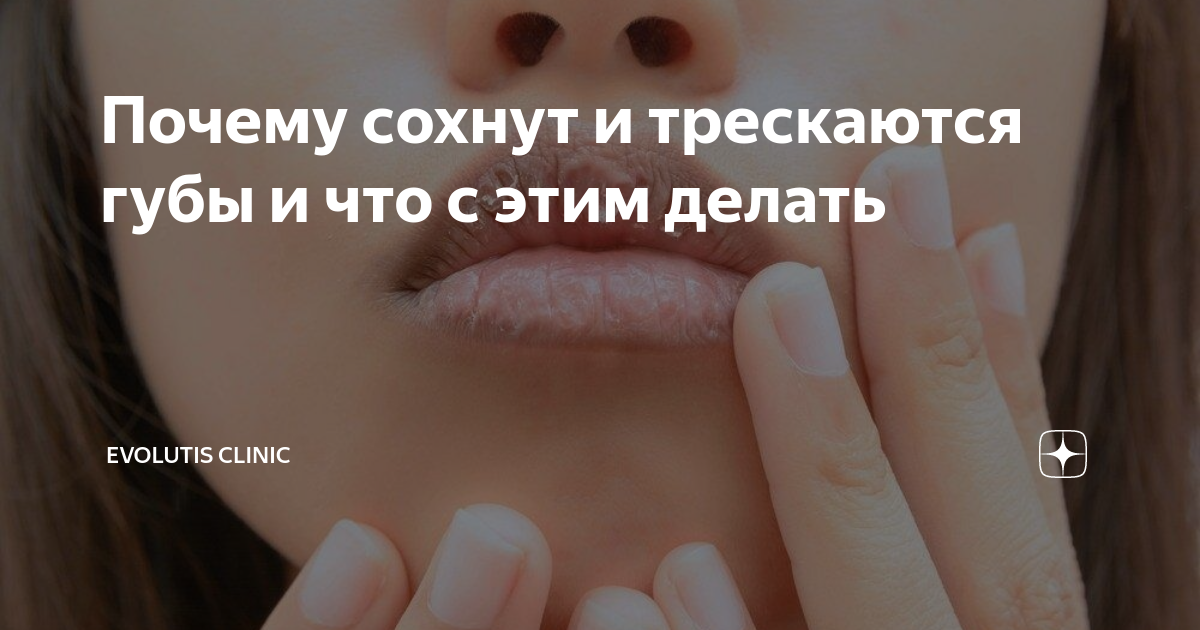 Уход за губами: что делать, если трескаются губы