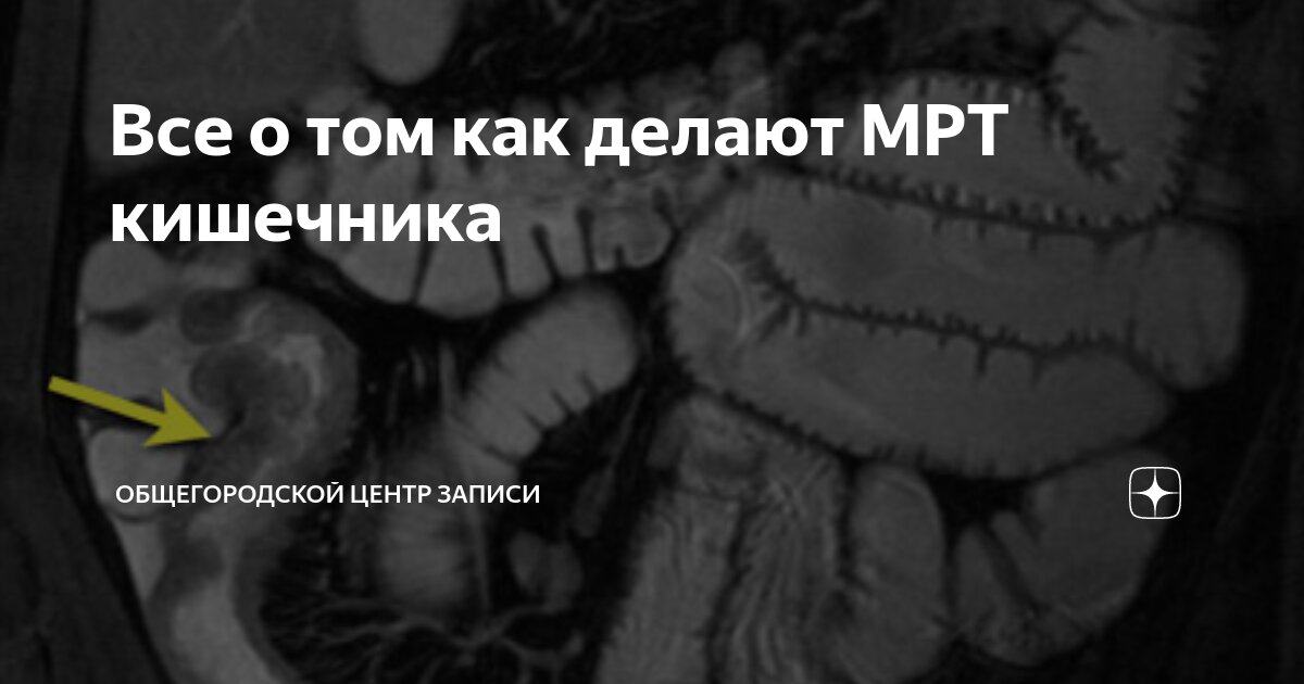 Можно сделать кт кишечника. Мрт тонкого и Толстого кишечника. Сигмовидная кишка кишечника на мрт.