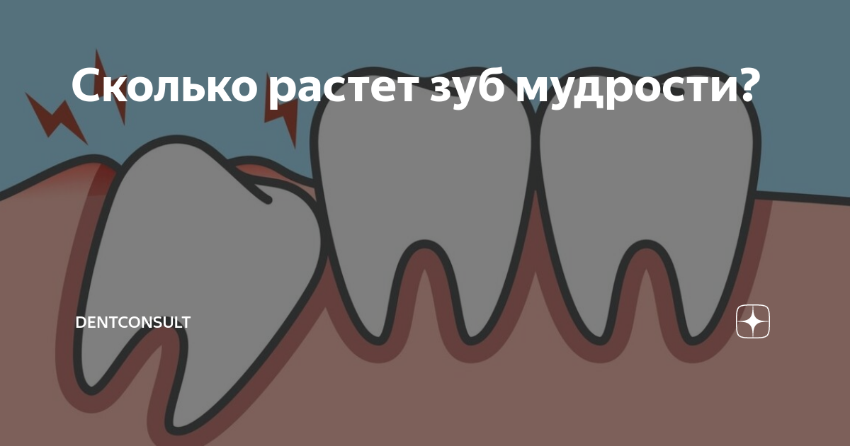 Насколько выросла. Прорезавшийся зуб мудрости. Прорезается зуб мудрости. Сколько растет зуб мудрости