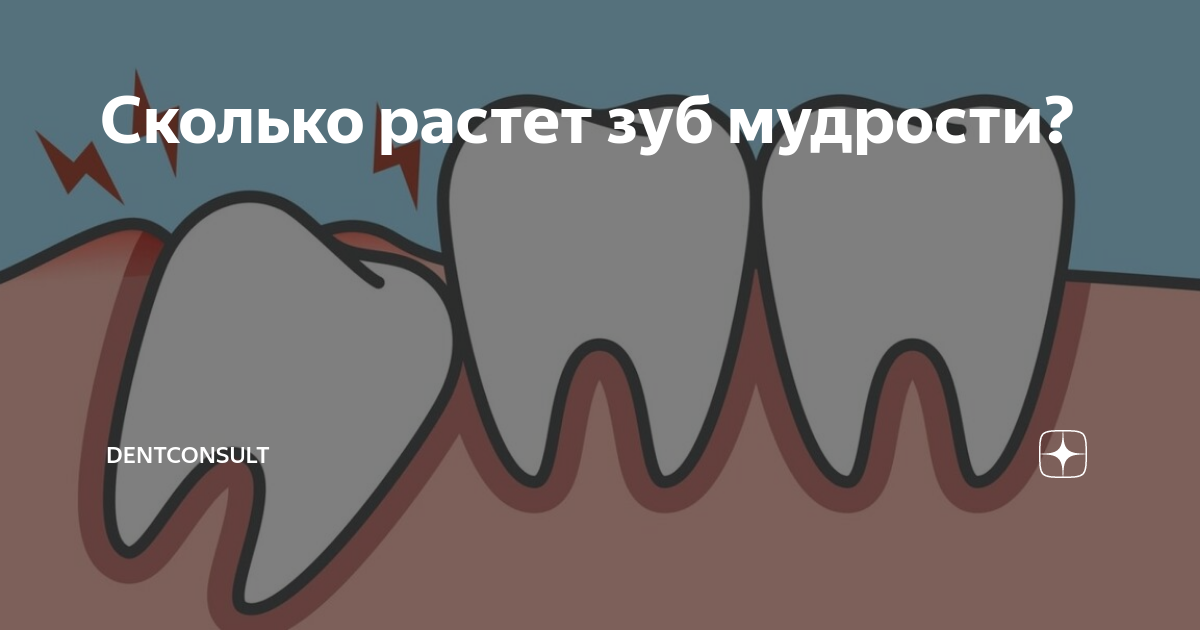 Как долго растут зубы мудрости. Прорезается зуб мудрости. Правильный зуб мудрости.