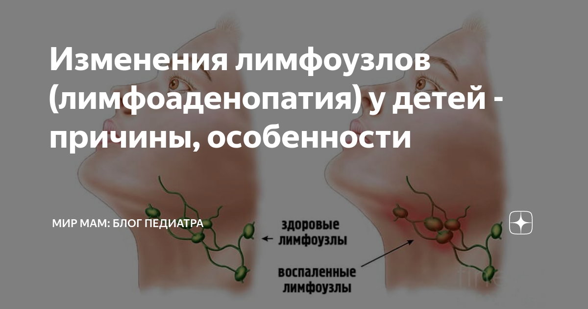 Лимфоузел в правом паху. Воспаленные лимфоузлы. Лимфатические узлы под мышкой.