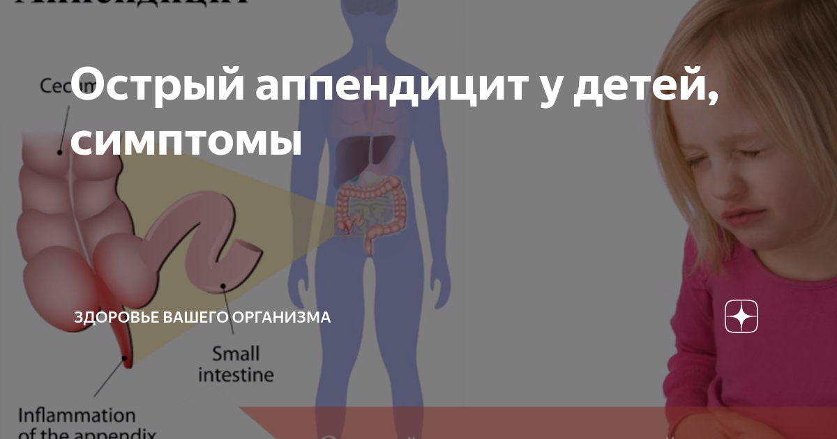 Аппендицит симптомы у детей без температуры. Аппендицит симптомы у детей. Симптомы детского аппендицита. Аппендикс у ребенка 6 лет. Признаки аппендицита у детей.