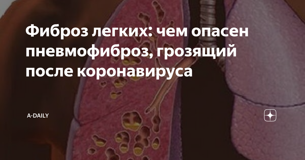 Пневмофиброз — нешуточное коварство. Как поддержать заболевшие лёгкие?