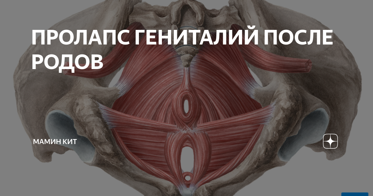 Пролапс женских органов. Опущение тазового дна после родов. Пролапс сводов влагалища.