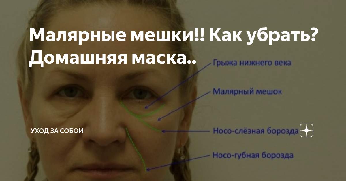 Почему под глазами мешки у мужчин причины. Малярные мешки. Малярные мешки под глазами. Малярный мешок слезная борозда. Как убрать малярные мешки