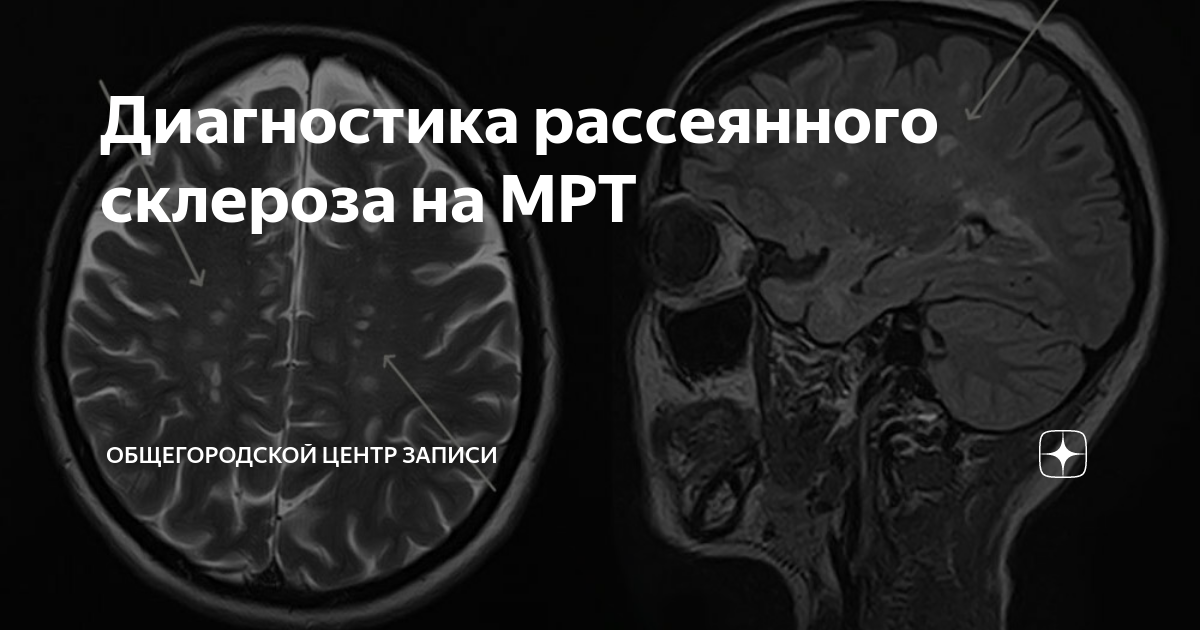 Рассеянный склероз на кт. Атипичные формы рассеянного склероза мрт. Активность рассеянного склероза по мрт. Мрт головного мозга при рассеянном склерозе. Как выглядит рассеянный склероз на мрт головного мозга.