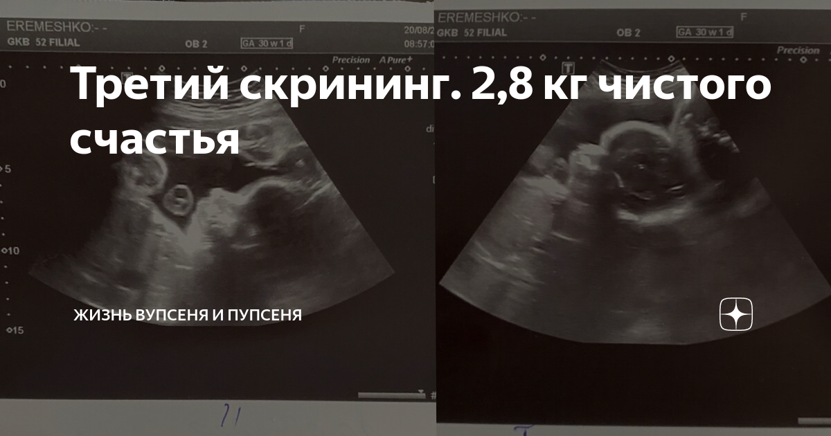 Узи при беременности 2 триместр. Скрининговое узи беременности. Узи 2 3 триместр беременности. Узи беременных. Узи скрининг.