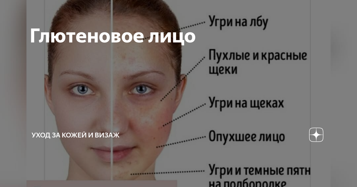 Как выглядит сахарное лицо Экология жизни.Скажи мне, что ты ешь, и я скажу тебе, откуда все проблемы с коже