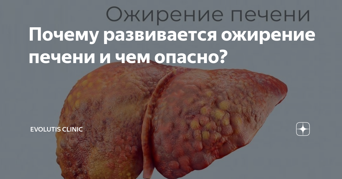 Почему развивается ожирение печени и чем опасно? | Evolutis Clinic | Дзен