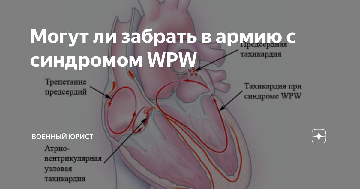 Классификация синдрома WPW