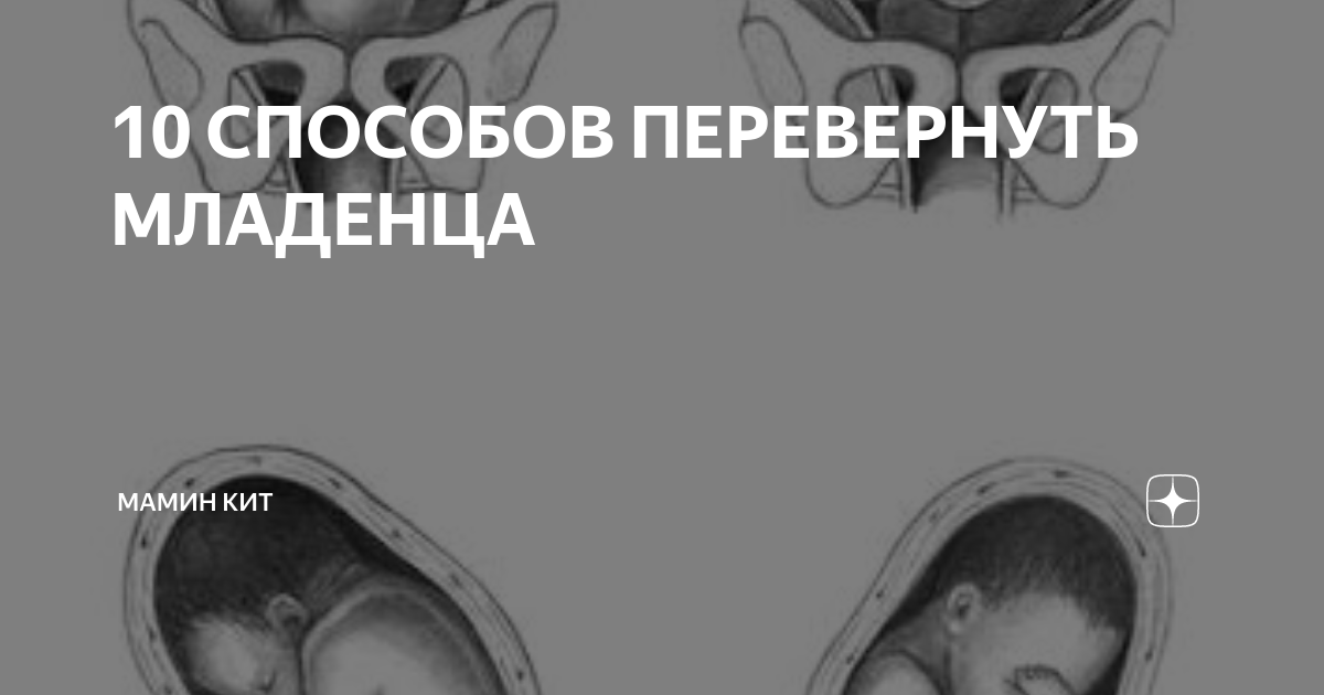 Тазовое предлежание плода: что это, как рожать, чем опасно, если ребёнок лежит ягодицами вниз