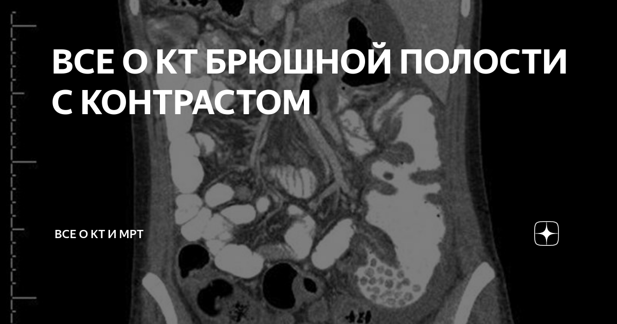 Как делают кт брюшной полости с контрастом фото