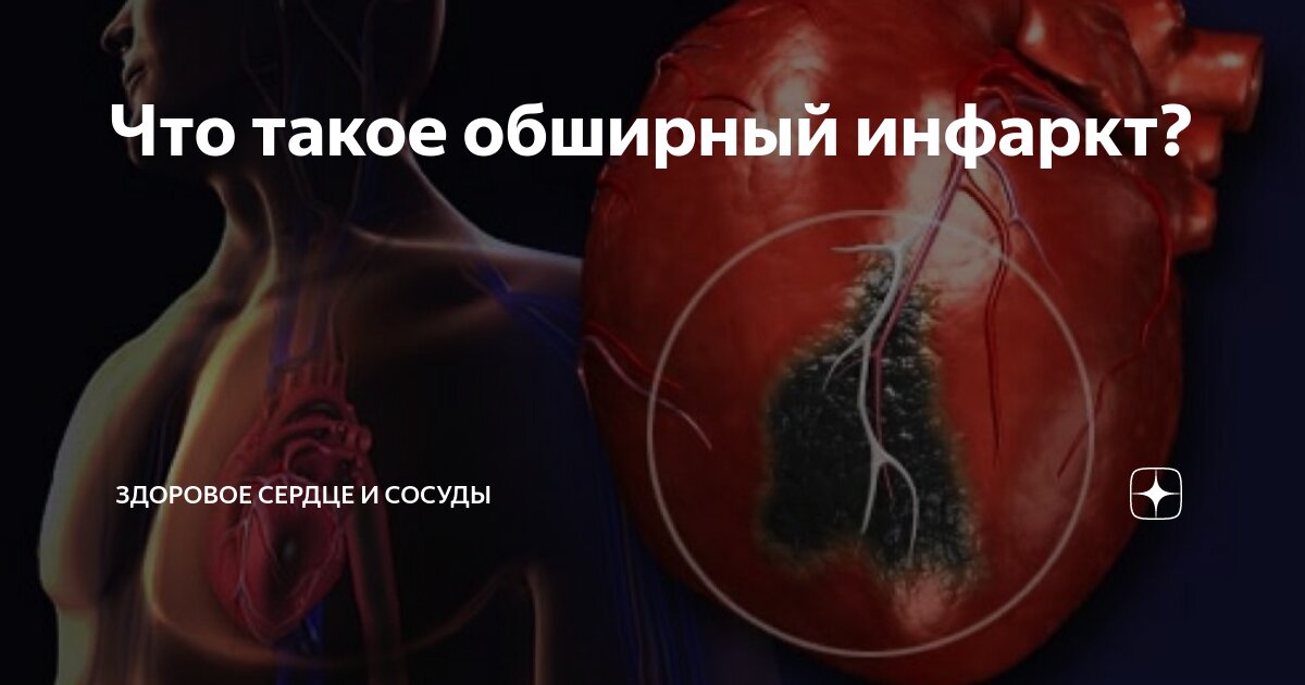 Что такое обширный инфаркт? | Анна Кореневич | Врач-кардиолог ...