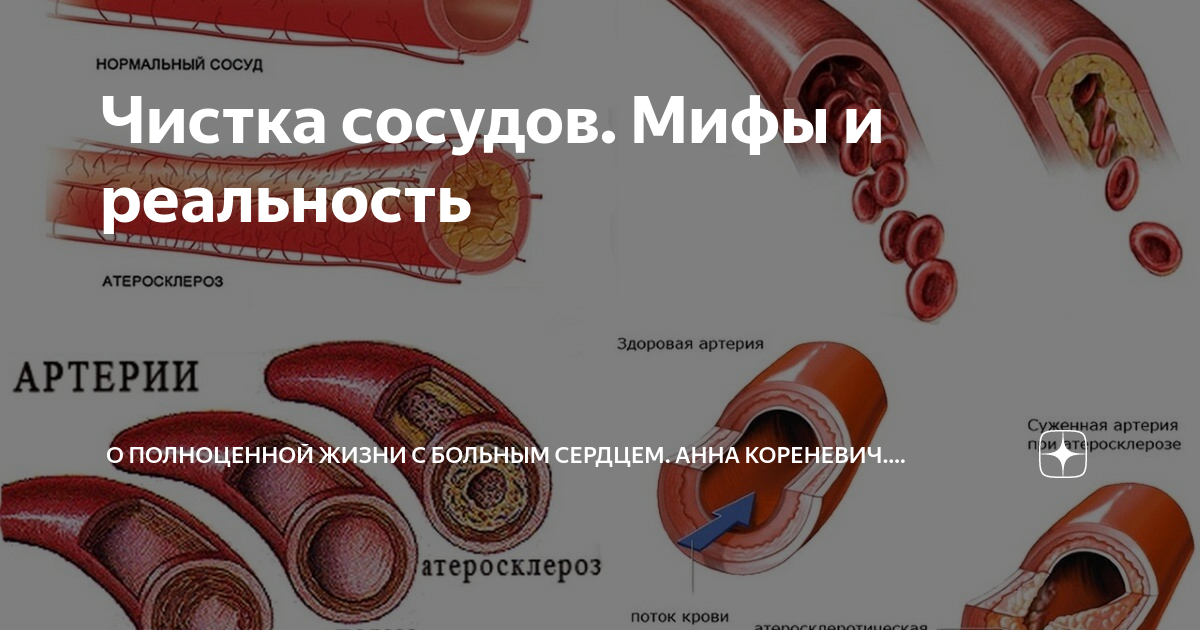 Атеросклероз сосудов нижних конечностей. Атеросклеротическое поражение коронарных сосудов. Как понять что сосуды забиты. Атеросклероза сосудов миф или реальность. Три продукта которые забивают сосуды.