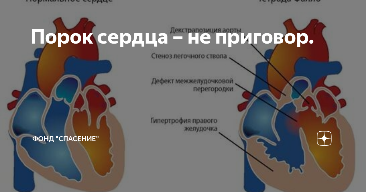 Порок сердца сколько. Заболевания приводящие к формированию пороков сердца.