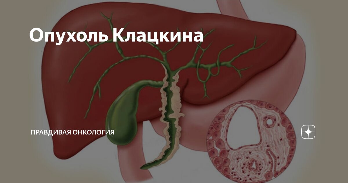 Злокачественные опухоли желчного пузыря