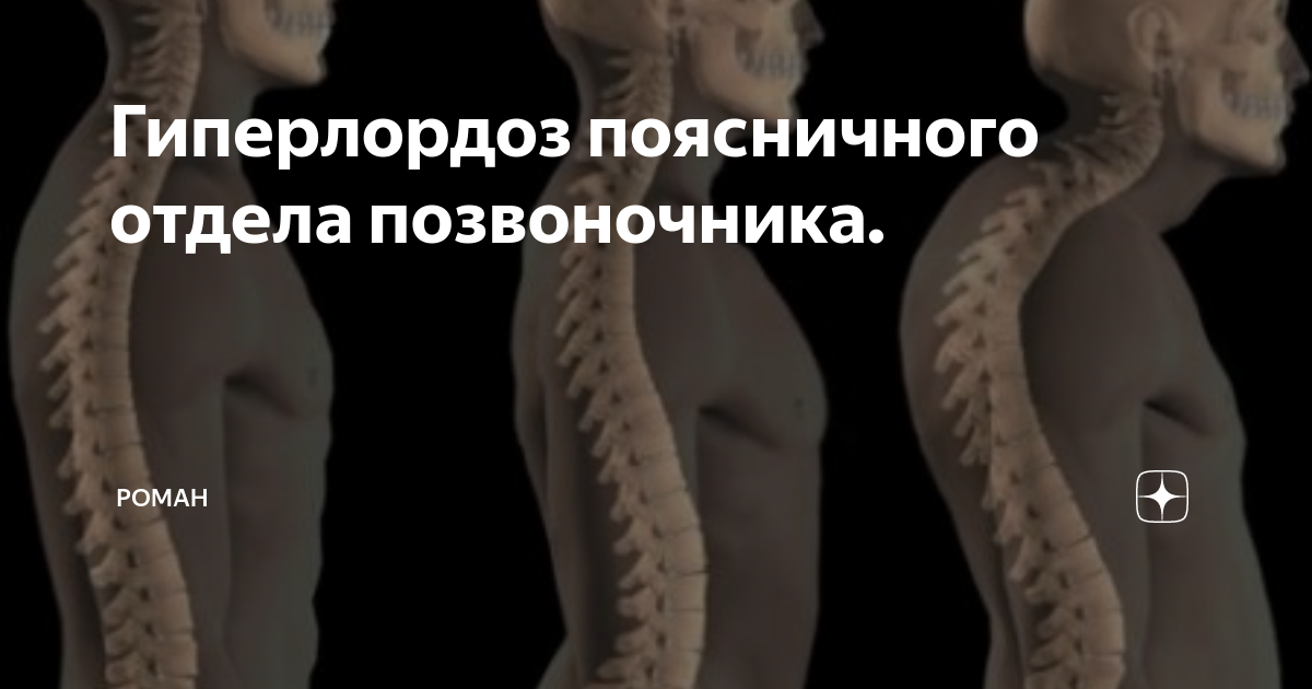 Как устранить гиперлордоз поясницы (излишний прогиб), который сопровождается вып