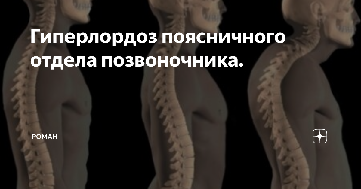 Что такое гиперлордоз поясничного отдела. Гиперлордоз поясничного отдела. Гиперлордоз позвоночника. Нестабильность позвоночника. Как убрать гиперлордоз поясничного отдела.