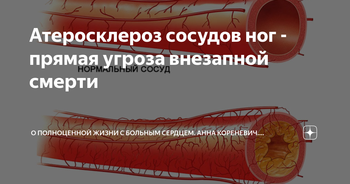 Атеросклероз артерий. Атеросклероз сосудов ног. Атеросклероз сосудов симптомы. Атеросклероз в/м сосудов.