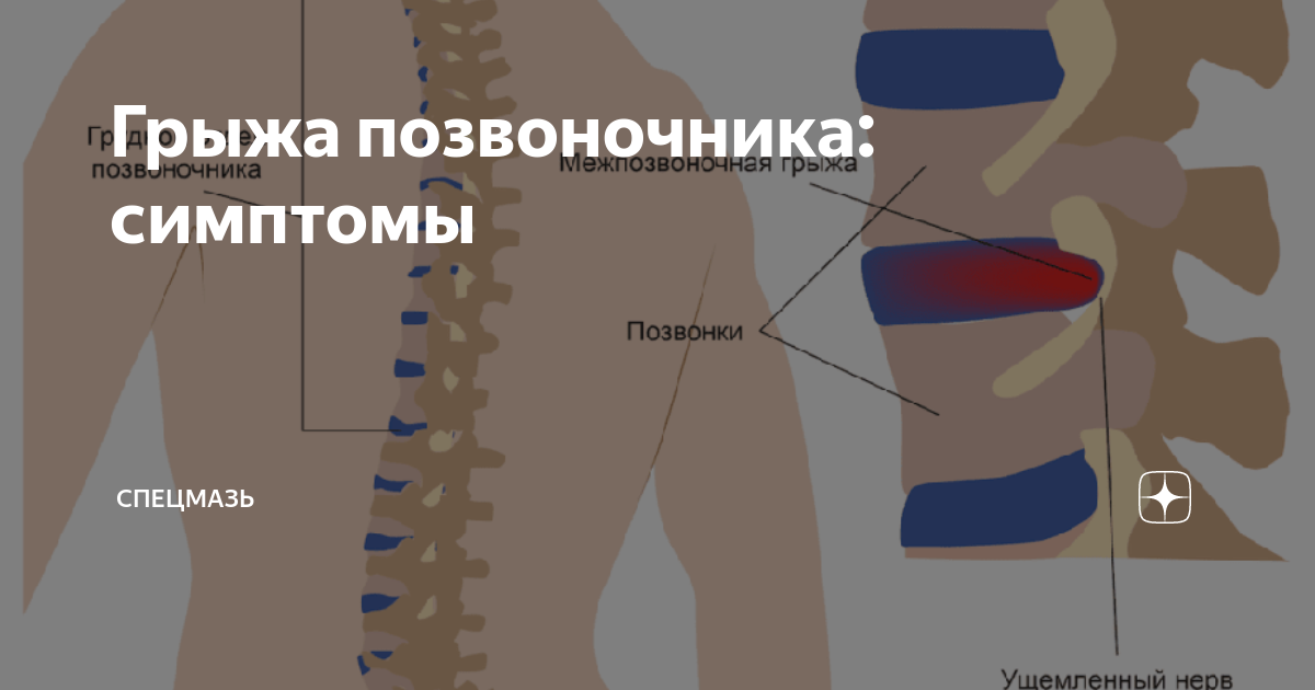 Грыжа позвоночника 8 мм. Процедура игла нож в китайской медицине.