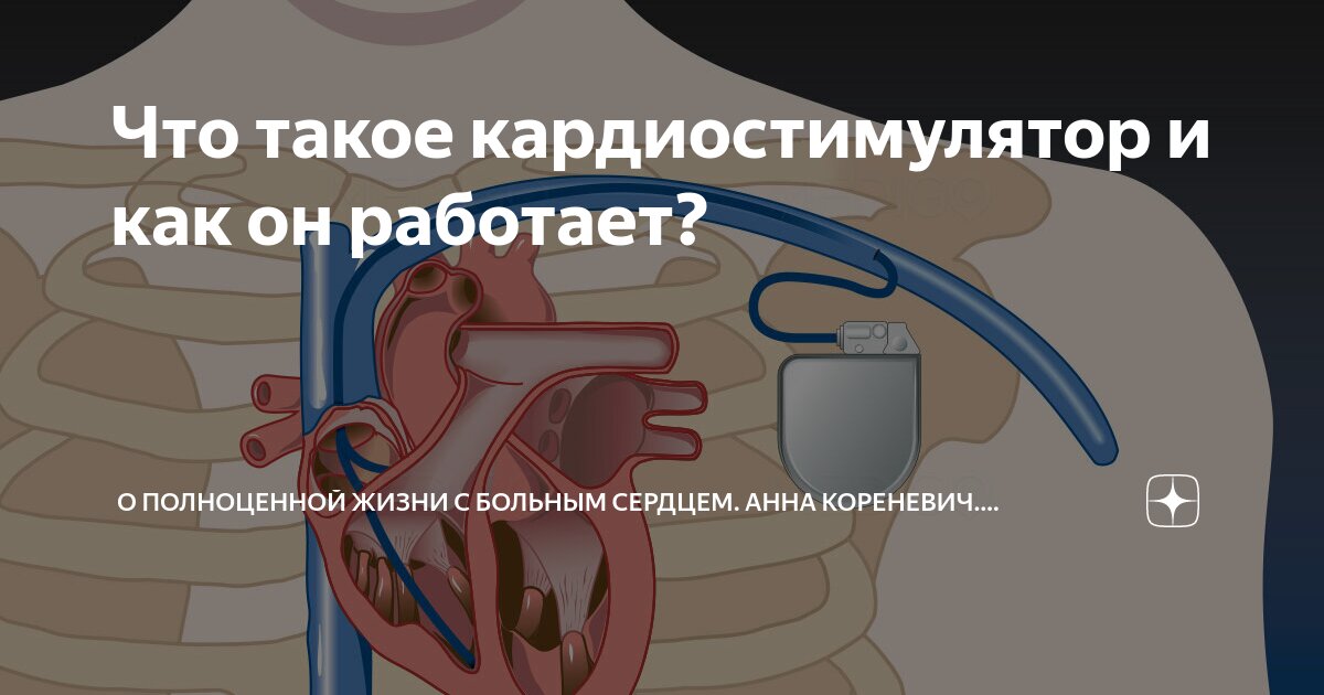 Почему в инструкции людям с кардиостимуляторами запрещается. Кардиостимулятор сердца. Однокамерный кардиостимулятор сердца. Памятка для пациентов с кардиостимулятором. Имплантация кардиостимулятора