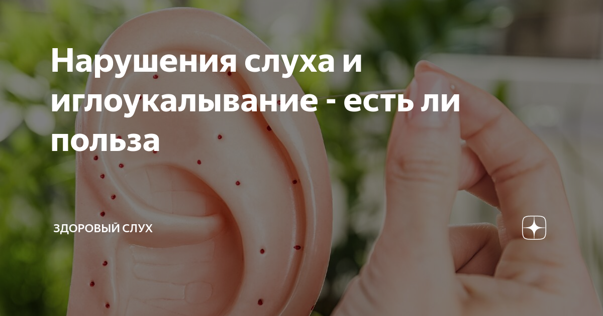 Нарушения слуха и иглоукалывание - есть ли польза | Здоровый слух | Дзен
